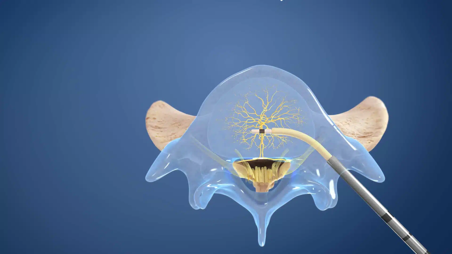 !Relievant_Intracept_Step 3