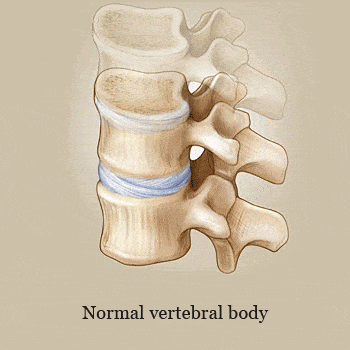 Kyphoplasty procedure