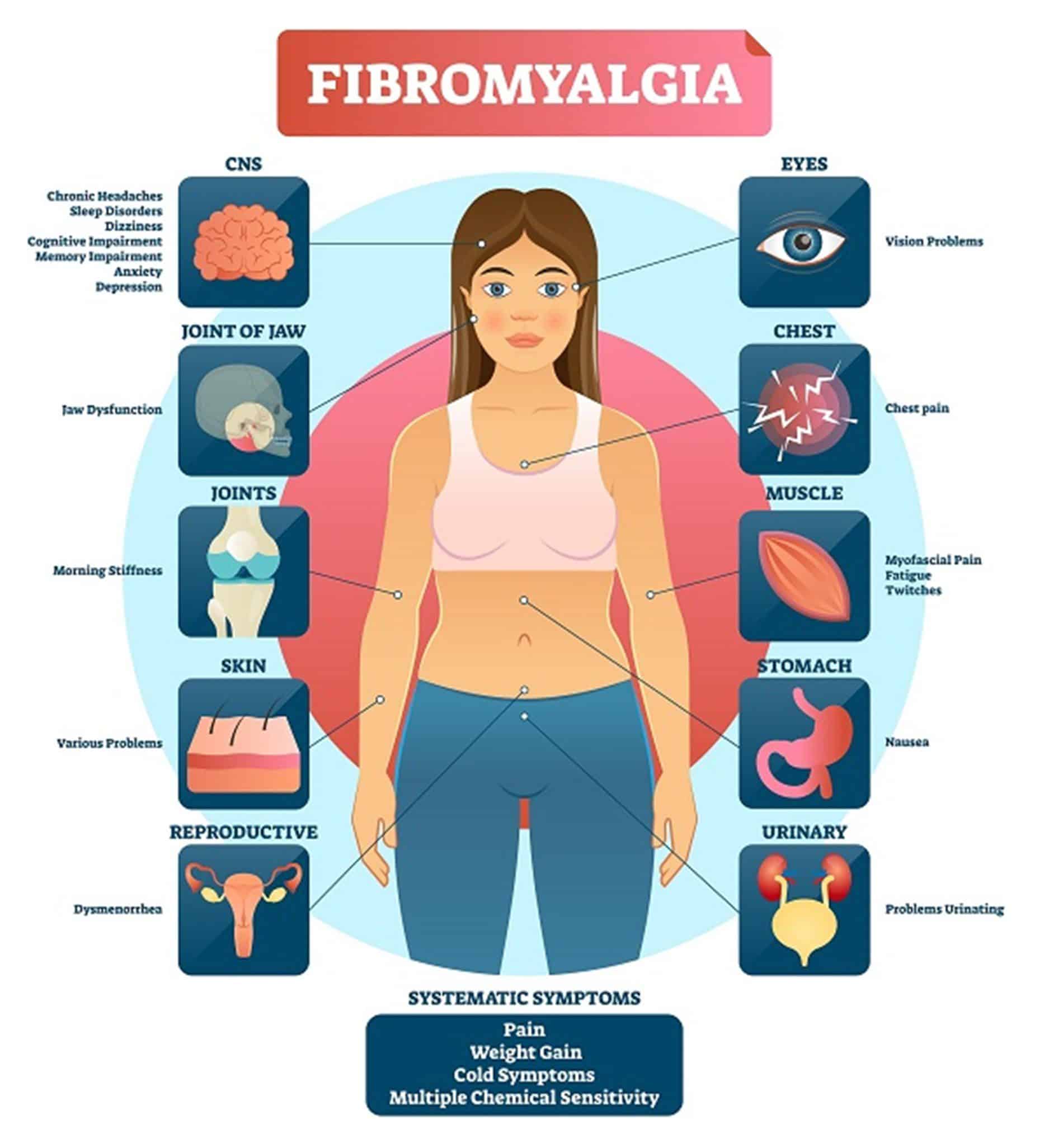 Fibromyalgia illustration