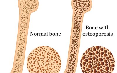 Exercise and Osteoporosis