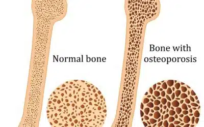 Exercise and Osteoporosis