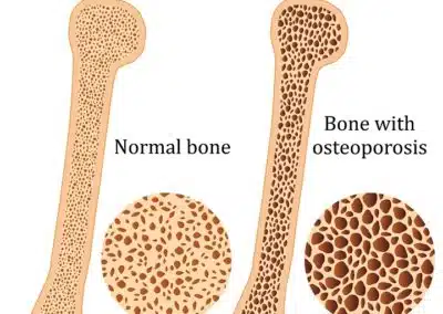 Exercise and Osteoporosis