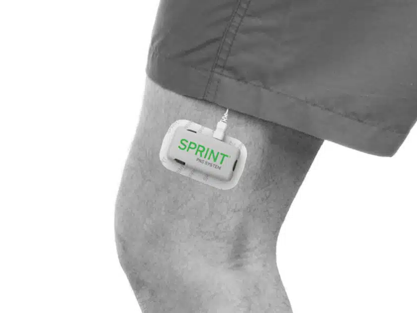 SPRINT PNS on knee SPRINT PNS device on knee