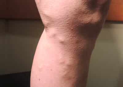 CVI Patient 1 before vein care procedure