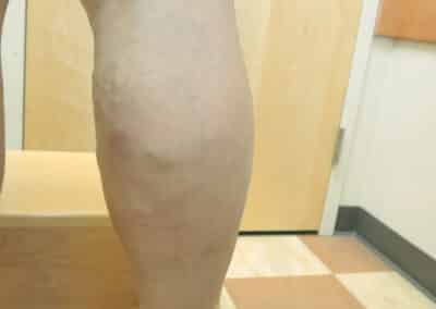 CVI Patient 3 after vein care procedure