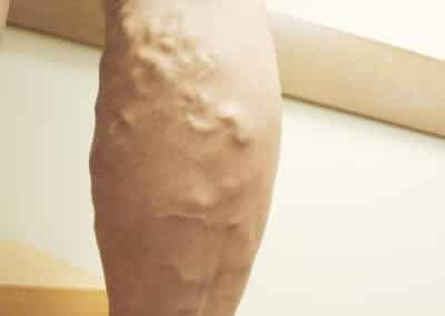 CVI Patient 3 before vein care procedure