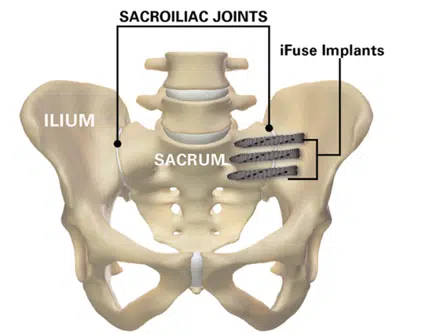 ifuse torq implants into pelvis illustration Sacroiliac Joint illustration